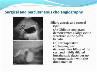Surgical and percutaneous cholangiography
Biliary atresia and central
cyst:
- (A) Oblique sonogram
demonstrates a large cystic
structure in the porta
hepatis.
- (B) Intraoperative
cholangiogram
demonstrates filling of the
cyst and mildly dilated
intrahepatic ducts but no
communication with the
duodenum m
 