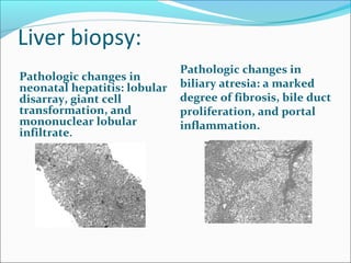 Liver biopsy:
Pathologic changes in
neonatal hepatitis: lobular
disarray, giant cell
transformation, and
mononuclear lobular
infiltrate.
Pathologic changes in
biliary atresia: a marked
degree of fibrosis, bile duct
proliferation, and portal
inflammation.
 