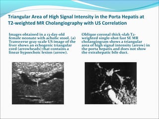 Triangular Area of High Signal Intensity in the Porta Hepatis at
T2-weighted MR Cholangiography with US Correlation
Images obtained in a 13-day-old
female neonate with acholic stool. (a)
Transverse gray-scale US image of the
liver shows an echogenic triangular
cord (arrowheads) that contains a
linear hypoechoic lesion (arrow).
Oblique coronal thick-slab T2-
weighted single-shot fast SE MR
cholangiogram shows a triangular
area of high signal intensity (arrow) in
the porta hepatis and does not show
the extrahepatic bile duct.
 