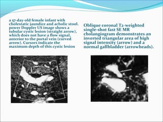 a 57-day-old female infant with
cholestatic jaundice and acholic stool.
power Doppler US image shows a
tubular cystic lesion (straight arrow),
which does not have a flow signal,
anterior to the portal vein (curved
arrow). Cursors indicate the
maximum depth of this cystic lesion
Oblique coronal T2-weighted
single-shot fast SE MR
cholangiogram demonstrates an
inverted triangular area of high
signal intensity (arrow) and a
normal gallbladder (arrowheads).
 
