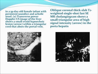 in a 59-day-old female infant with
persistent jaundice and acholic
stool. (a) Transverse power
Doppler US image of the liver
shows a small ovoid hypoechoic
lesion (arrow) within a triangular
cord that abuts the portal vein.
Oblique coronal thick-slab T2-
weighted single-shot fast SE
MR cholangiogram shows a
small triangular area of high
signal intensity (arrow) in the
porta hepatis
 