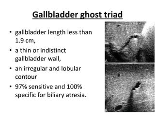 Gallbladder ghost triad
• gallbladder length less than
1.9 cm,
• a thin or indistinct
gallbladder wall,
• an irregular and lobular
contour
• 97% sensitive and 100%
specific for biliary atresia.
 
