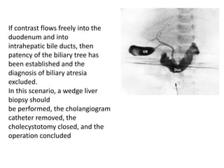 If contrast flows freely into the
duodenum and into
intrahepatic bile ducts, then
patency of the biliary tree has
been established and the
diagnosis of biliary atresia
excluded.
In this scenario, a wedge liver
biopsy should
be performed, the cholangiogram
catheter removed, the
cholecystotomy closed, and the
operation concluded
 