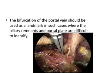 • The bifurcation of the portal vein should be
used as a landmark in such cases where the
biliary remnants and portal plate are difficult
to identify.
 