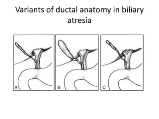 Variants of ductal anatomy in biliary
atresia
 