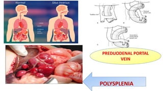 PREDUODENAL PORTAL
VEIN
POLYSPLENIA
 
