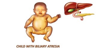 CHILD WITH BILIARY ATRESIA
 