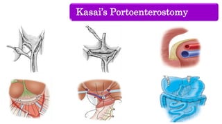 Kasai’s Portoenterostomy
 