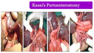 Kasai’s Portoenterostomy
 