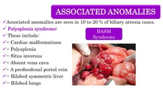 ASSOCIATED ANOMALIES
Associated anomalies are seen in 10 to 20 % of biliary atresia cases.
 Polysplenia syndrome:
 These include:
− Cardiac malformations
− Polysplenia
− Situs inversus
− Absent vena cava
− A preduodenal portal vein
-- Bilobed symmetric liver
-- Bilobed lungs
BASM
Syndrome
 