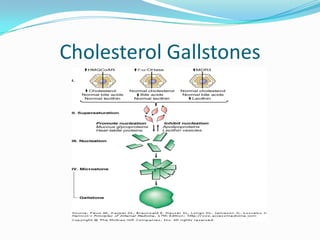 Cholesterol Gallstones