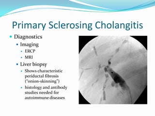 Primary SclerosingCholangitisDiagnosticsImagingERCPMRILiver biopsyShows characteristic periductal fibrosis (“onion-skinning”)histology and antibody studies needed for autoimmune diseases