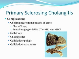 Primary SclerosingCholangitisComplicationsCholangiocarcinoma in 20% of casesCheck CA 19-9Annual imaging with U/s, CT or MRI with MRCPGallstonesCholecystitisGallbladder polypsGallbladder carcinoma