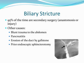 Biliary Stricture95% of the time are secondary surgery (anastomosis or injury)Other causes: Blunt trauma to the abdomenPancreatitisErosion of the duct by gallstonePrior endoscopic sphincterotomy