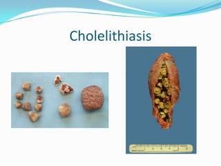 Cholelithiasis