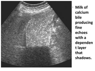 • Milk of 
calcium 
bile 
producing 
fine 
echoes 
with a 
dependen 
t layer 
that 
shadows. 
 