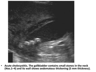 • Acute cholecystitis. The gallbladder contains small stones in the neck 
(Nos.1–4) and its wall shows oedematous thickening (5 mm thickness). 
 