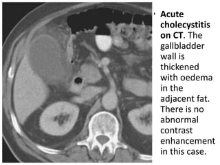• Acute 
cholecystitis 
on CT. The 
gallbladder 
wall is 
thickened 
with oedema 
in the 
adjacent fat. 
There is no 
abnormal 
contrast 
enhancement 
in this case. 
 