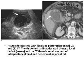 • Acute cholecystitis with localized perforation on (A) US 
and (B) CT. The thickened gallbladder wall shows a local 
defect (arrow) and on CT there is small amount of 
intraperitoneal fluid and oedema of adjacent fat. 
 