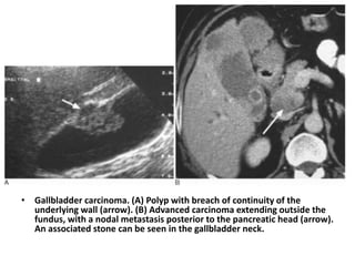 • Gallbladder carcinoma. (A) Polyp with breach of continuity of the 
underlying wall (arrow). (B) Advanced carcinoma extending outside the 
fundus, with a nodal metastasis posterior to the pancreatic head (arrow). 
An associated stone can be seen in the gallbladder neck. 
 