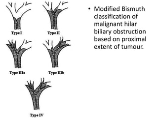 • Modified Bismuth 
classification of 
malignant hilar 
biliary obstruction 
based on proximal 
extent of tumour. 
 