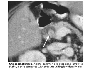 • Choledocholithiasis. A distal common bile duct stone (arrow) is 
slightly dense compared with the surrounding low-density bile. 
 