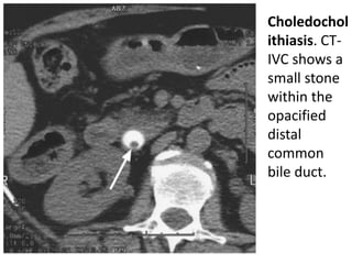 • Choledochol 
ithiasis. CT-IVC 
shows a 
small stone 
within the 
opacified 
distal 
common 
bile duct. 
 