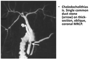 • Choledocholithias 
is. Single common 
duct stone 
(arrow) on thick-section, 
oblique, 
coronal MRCP. 
 