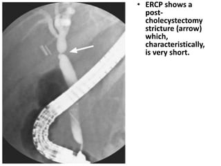 • ERCP shows a 
post-cholecystectomy 
stricture (arrow) 
which, 
characteristically, 
is very short. 
 