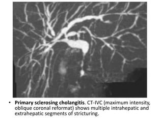 • Primary sclerosing cholangitis. CT-IVC (maximum intensity, 
oblique coronal reformat) shows multiple intrahepatic and 
extrahepatic segments of stricturing. 
 