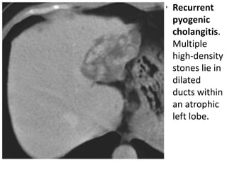 • Recurrent 
pyogenic 
cholangitis. 
Multiple 
high-density 
stones lie in 
dilated 
ducts within 
an atrophic 
left lobe. 
 