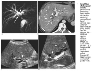 • Small hilar 
cholangiocar 
cinoma 
(arrowhead) 
producing 
obstruction 
of the right 
posterior 
sectoral duct 
(short 
arrow), right 
anterior 
sectoral duct 
(long arrow) 
and left 
hepatic duct. 
(A) Thick 
section 
oblique 
coronal 
MRCP. (B) 
Axial portal 
phase CT. (C) 
Longitudinal 
US. (D) 
Transverse 
colour 
Doppler US 
(open arrow: 
normal left 
portal vein). 
 