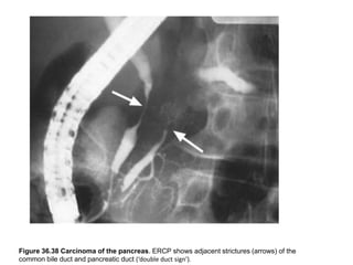 Figure 36.38 Carcinoma of the pancreas. ERCP shows adjacent strictures (arrows) of the 
common bile duct and pancreatic duct (‘double duct sign’). 

