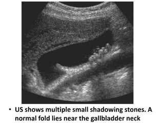 • US shows multiple small shadowing stones. A 
normal fold lies near the gallbladder neck 
 