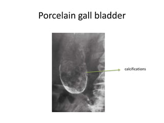 Gallbladder Calcium Biliary system anatomy,physiology & investigations | PPTX