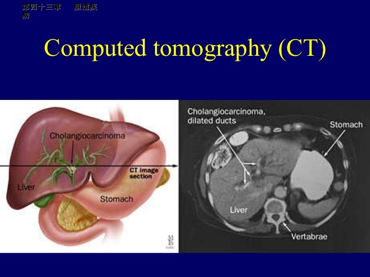 рак протоков печени. рак протоков печени. рак протоков печени. опухоль клацкина iv типа. холангиокарцинома печени гистология.