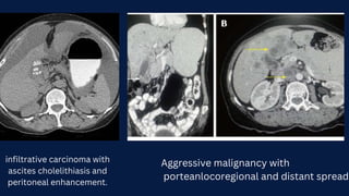 Biliary Tract Tumours(Cholangiocarcinoma,Cystadenoma/cystadenocarcinoma,Gall Bladder tumours). Radiology