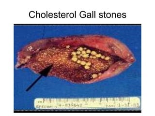 Cholesterol Gall stones
 