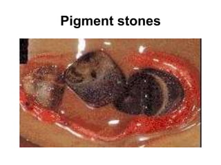 Pigment stones
 