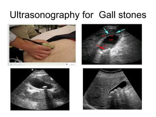 Ultrasonography for Gall stones
 