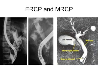 ERCP and MRCP
 