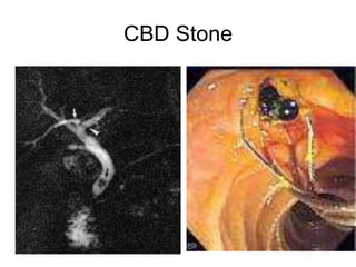 CBD Stone
 