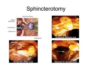 Sphincterotomy
 