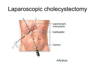 Laparoscopic cholecystectomy
 