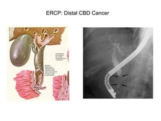 ERCP: Distal CBD Cancer
 