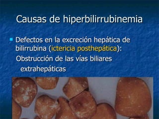 Causas de hiperbilirrubinemia Defectos en la excreción hepática de bilirrubina ( ictericia posthepática ): Obstrucción de las vías biliares  extrahepáticas 