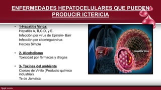 ENFERMEDADES HEPATOCELULARES QUE PUEDEN
PRODUCIR ICTERICIA
• 1-Hepatitis Vírica:
Hepatitis A, B,C,D, y E.
Infección por virus de Epstein- Barr
Infección por citomegalovirus
Herpes Simple
• 2- Alcoholismo
Toxicidad por fármacos y drogas
• 3- Toxinas del ambiente
Cloruro de Vinilo (Producto químico
industrial)
Te de Jamaica
 