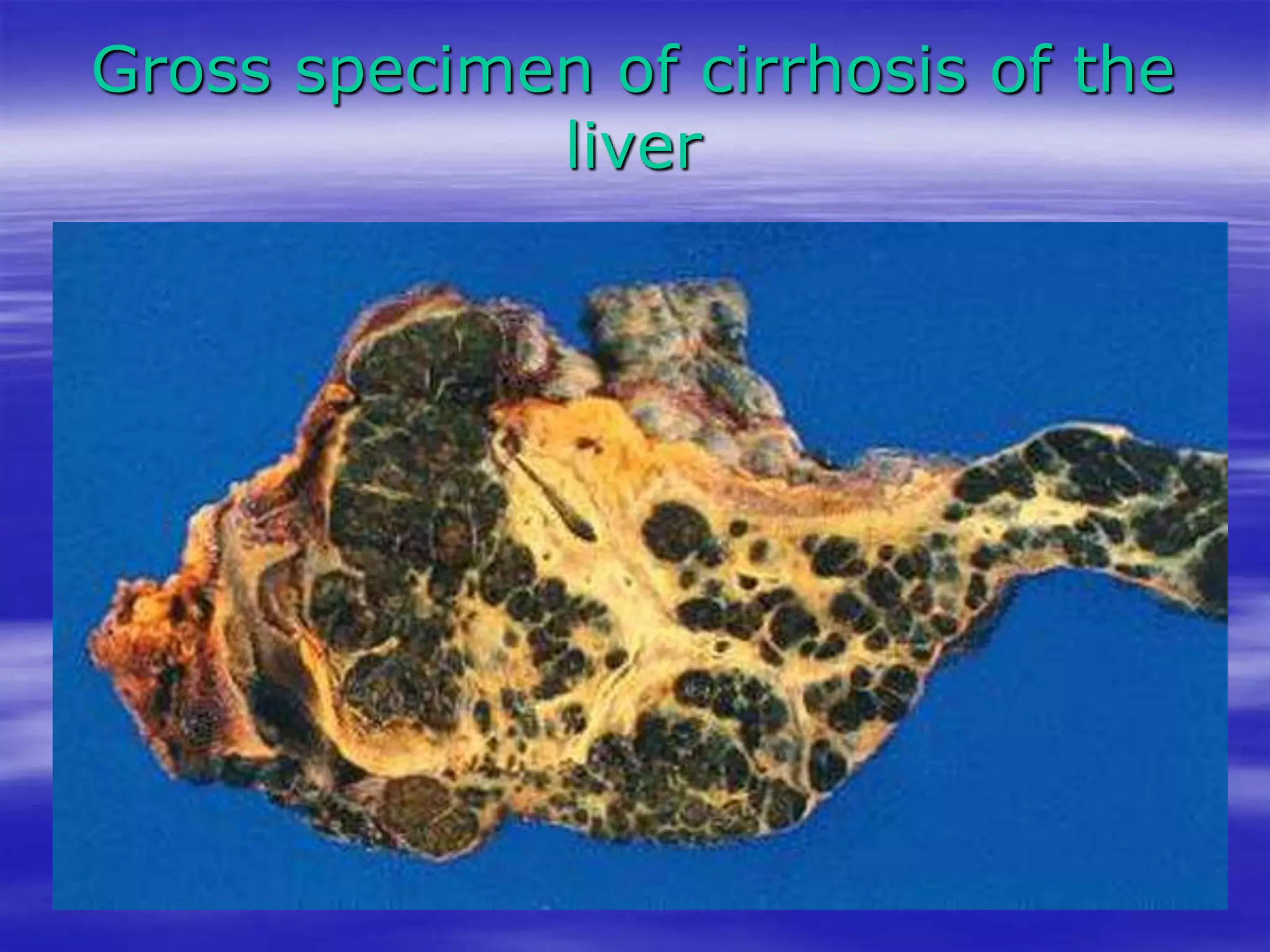 Gross specimen of cirrhosis of the
liver
 