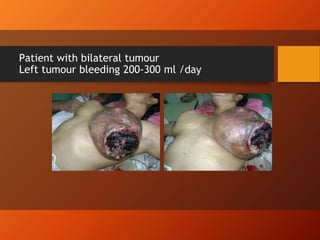 Patient with bilateral tumour
Left tumour bleeding 200-300 ml /day
 