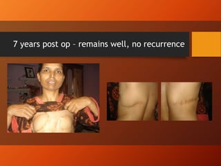 7 years post op – remains well, no recurrence
 